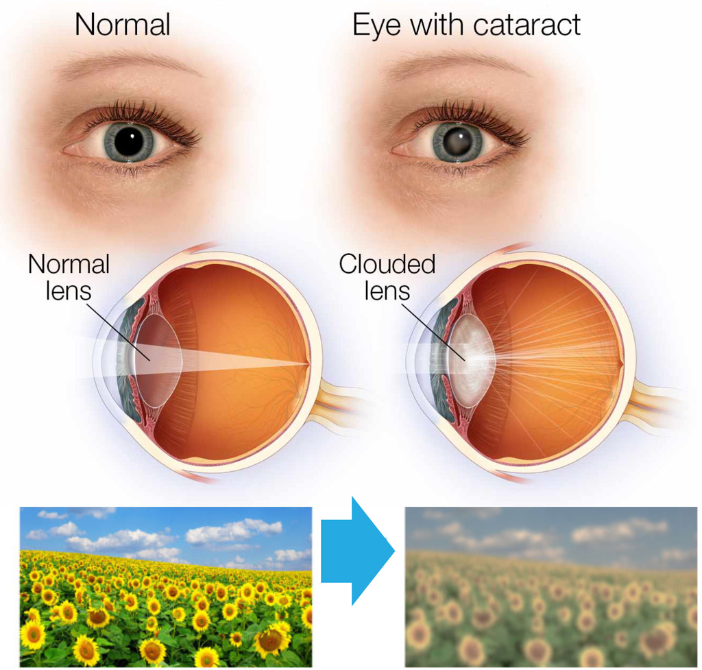 Cataract vision comparison