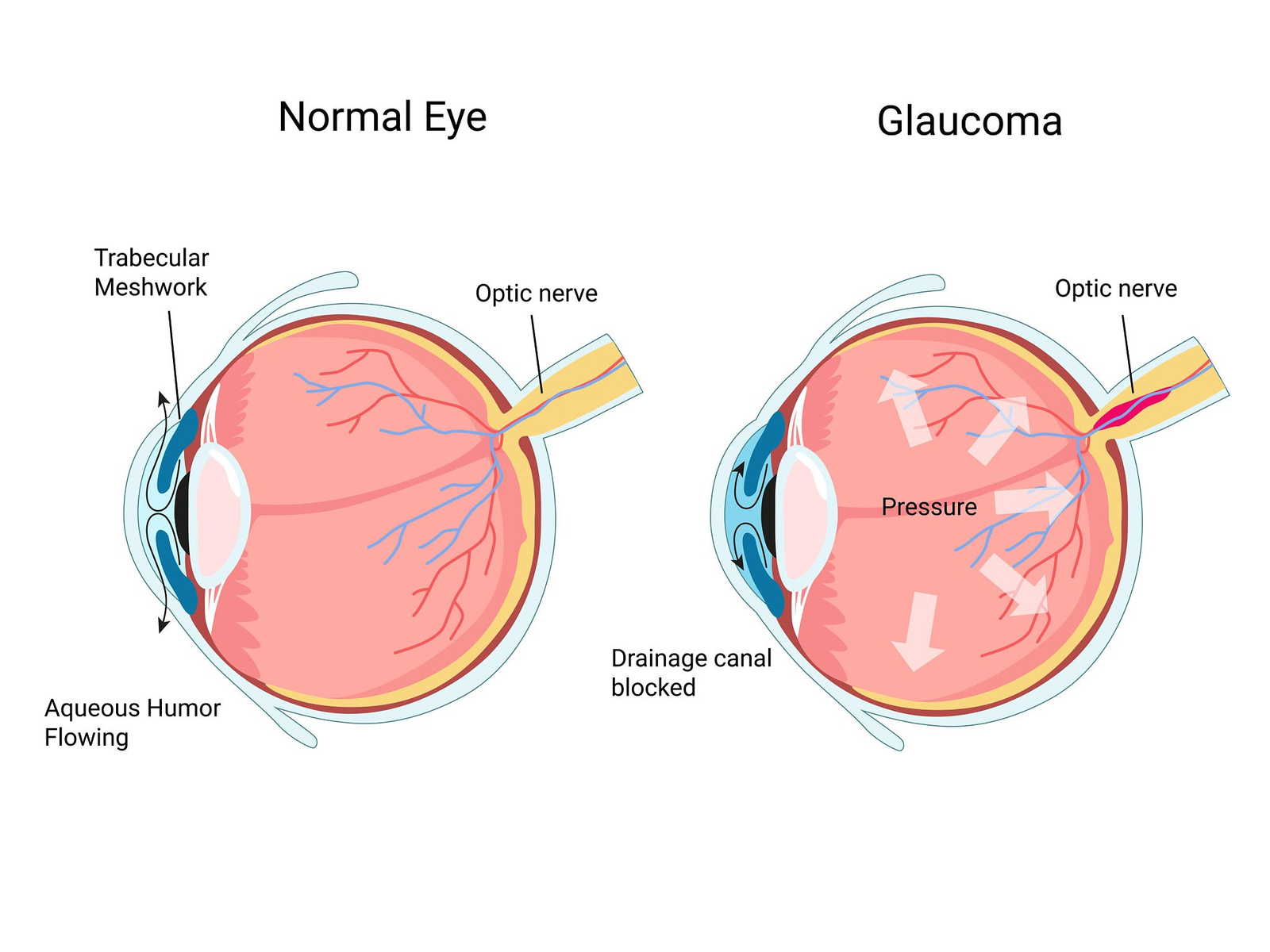 Normal eye drainage versus glaucoma with blocked drainage and optic nerve damage