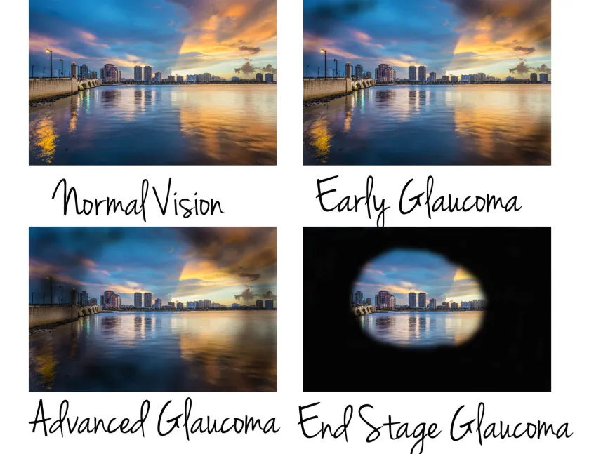 Glaucoma silent thief of sight